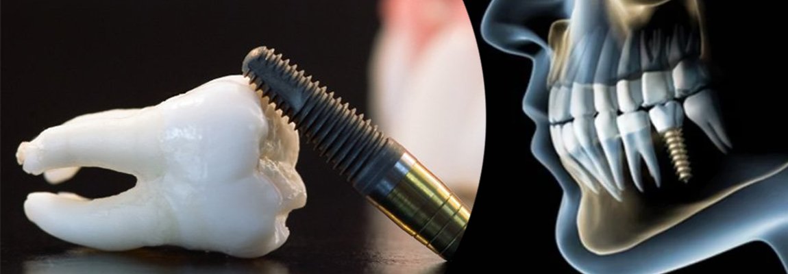 Dental Implants in Warje