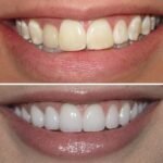 Teeth Whitening Treatments