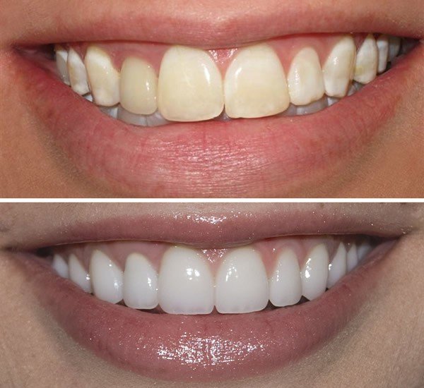 Teeth Whitening Treatments