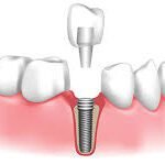 Dental Implants vs. Other Tooth Replacement Options