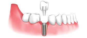 Dental Implants vs. Other Tooth Replacement Options