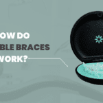 How Invisible Braces Work: A Simple Guide