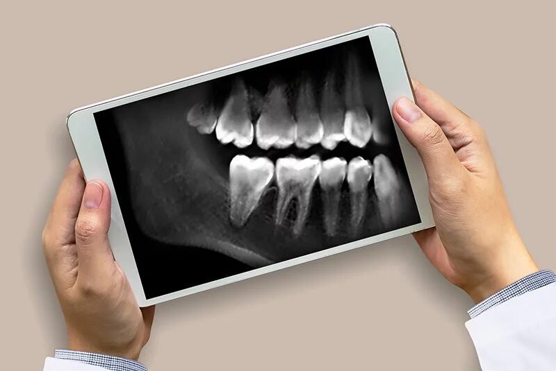 Why Are Dental X-Rays Essential for Oral Health